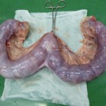 子宮（異常） のコピー